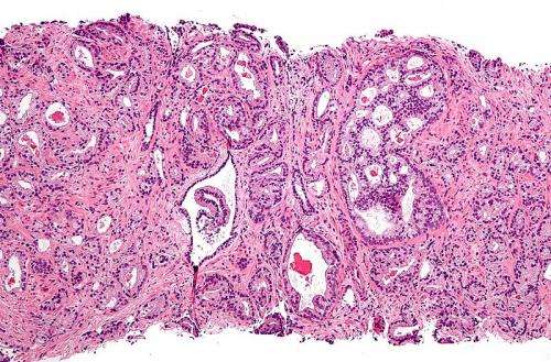prostatecanc